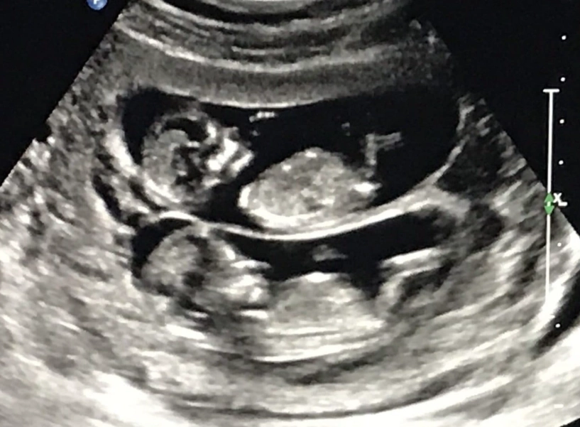 first trimester screening