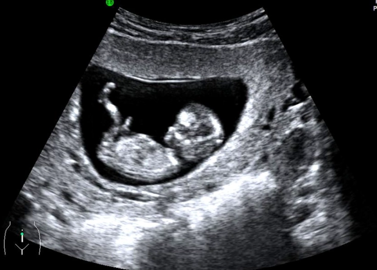 first trimester screening