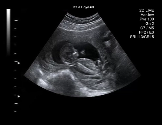 nuchal translucency scan