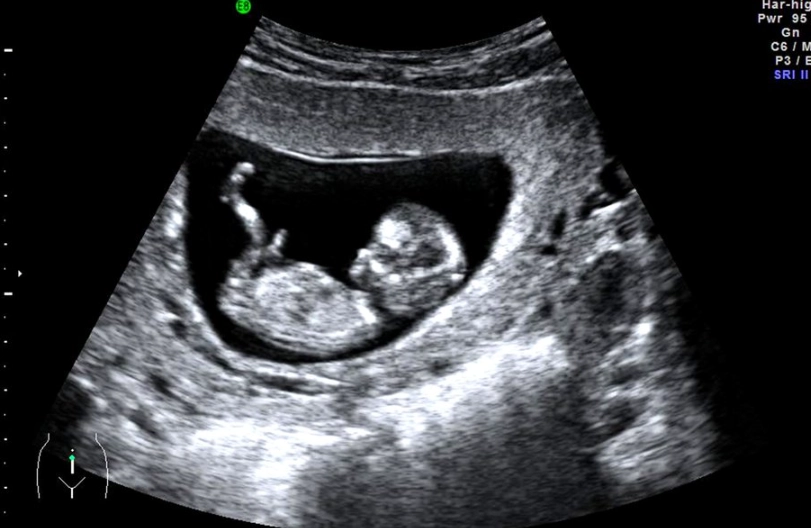 pregnancy week by month