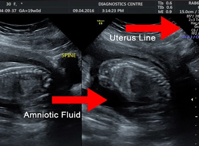 understanding ultrasound scan results
