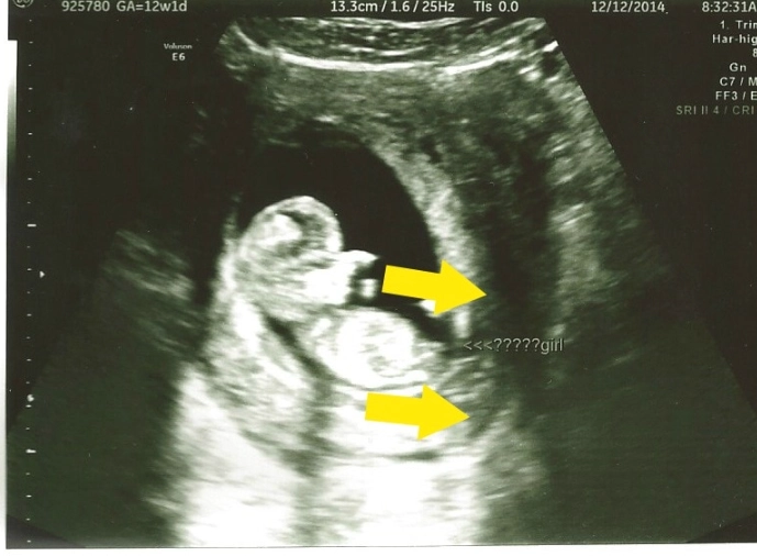 can you feel the baby at 12 weeks can you feel the baby at 12 weeks