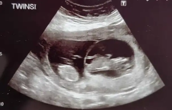 good signs at 12 weeks