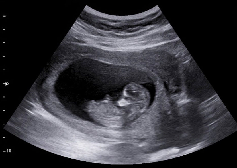 first trimester ultrasound first trimester ultrasound
