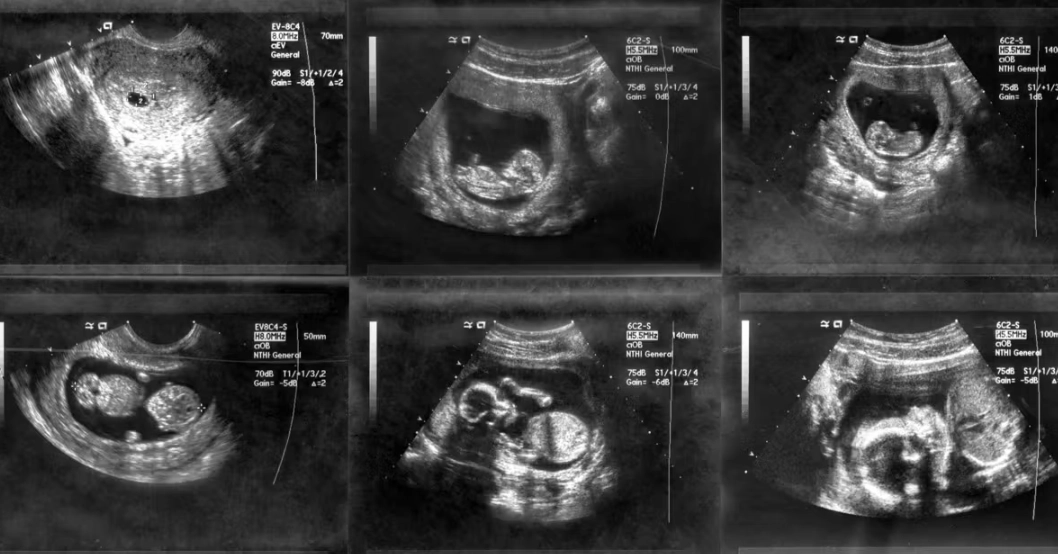 early pregnancy ultrasound early pregnancy ultrasound