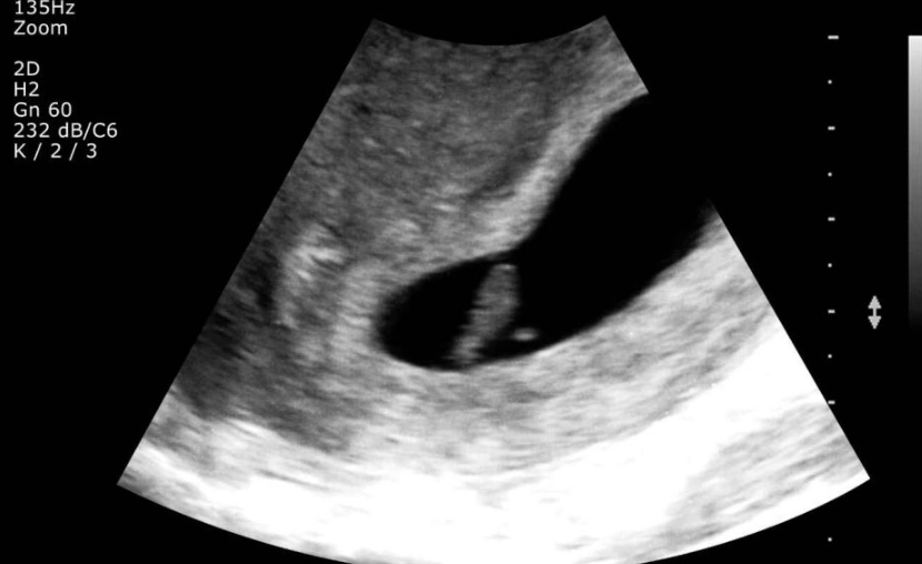 early pregnancy ultrasound early pregnancy ultrasound