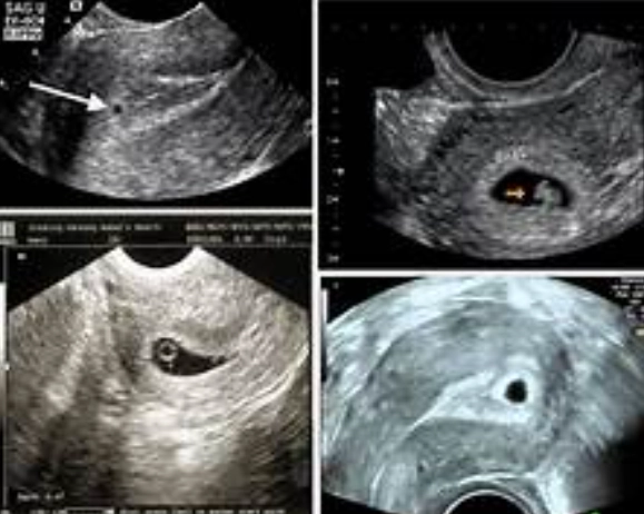 first trimester ultrasound first trimester ultrasound