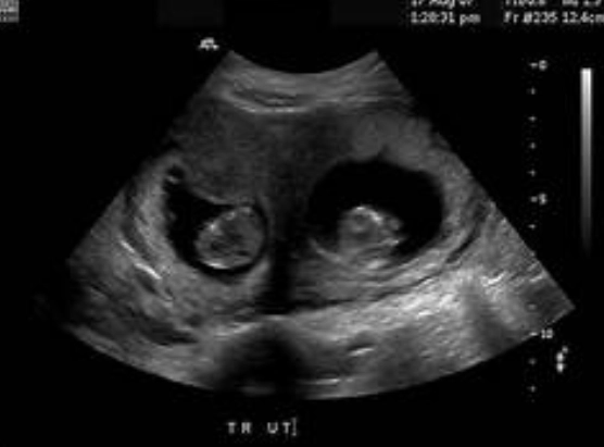 1 month pregnancy ultrasound 1 month pregnancy ultrasound