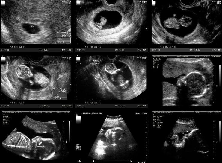 1 month pregnancy ultrasound 1 month pregnancy ultrasound