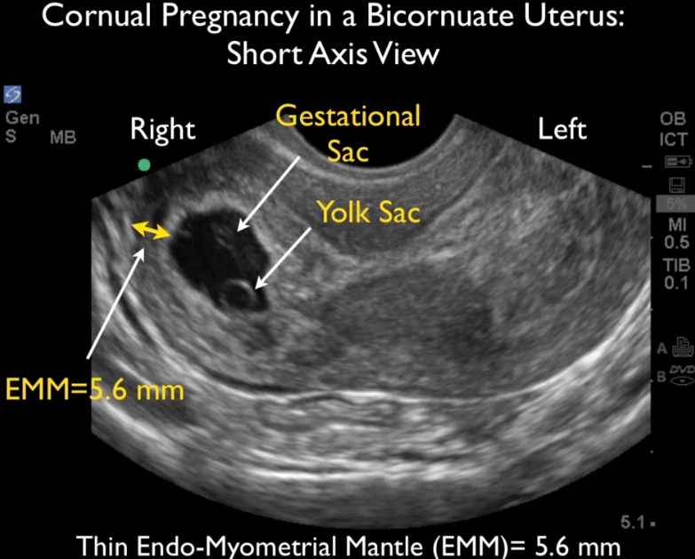 1 week pregnant symptoms
