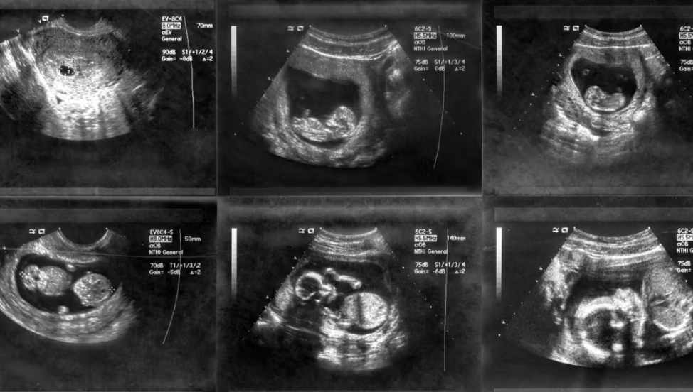 1 week pregnant symptoms