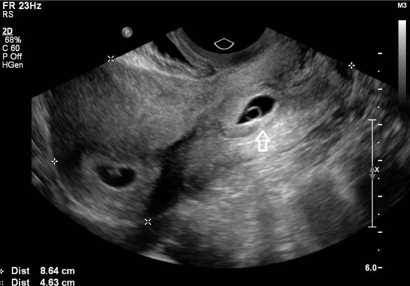 first trimester bleeding first trimester bleeding