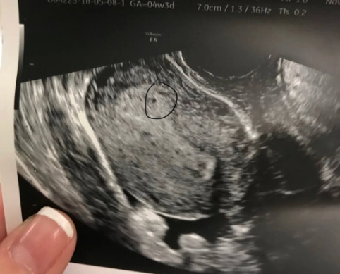 4 weeks pregnant symptoms