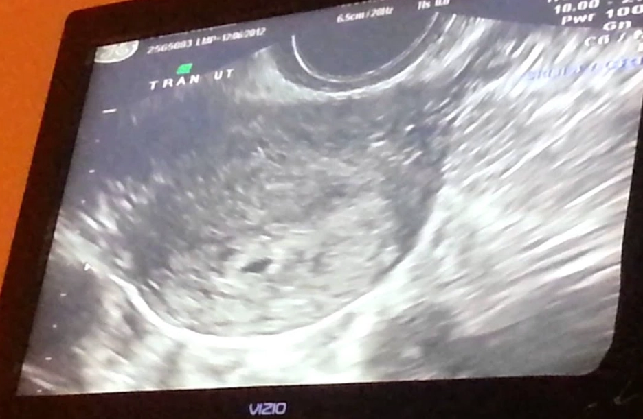 early pregnancy signs