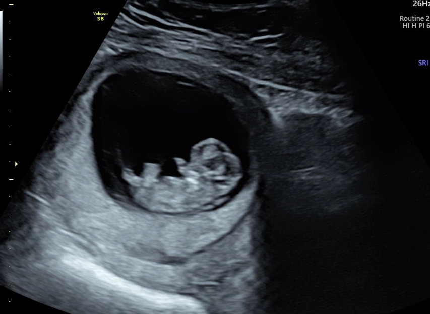 early pregnancy symptoms