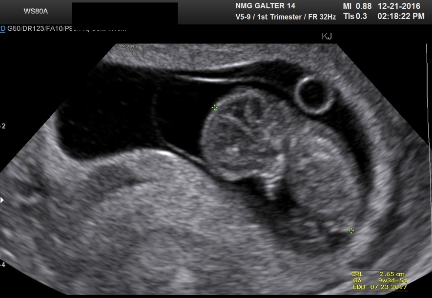 first trimester pregnancy week by week first trimester pregnancy week by week