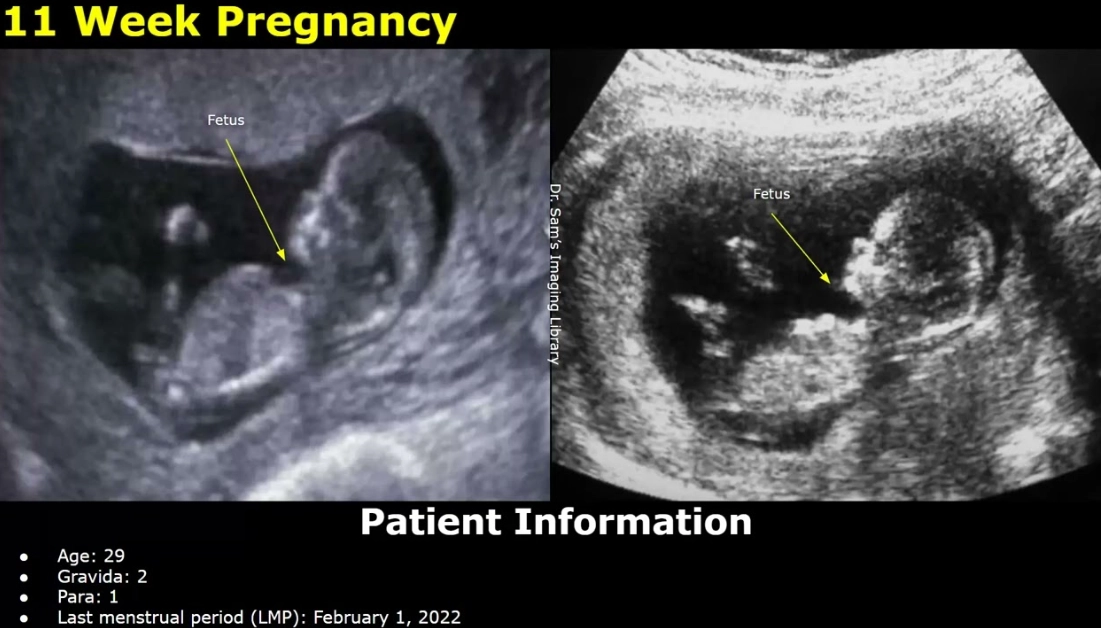 most critical week first trimester