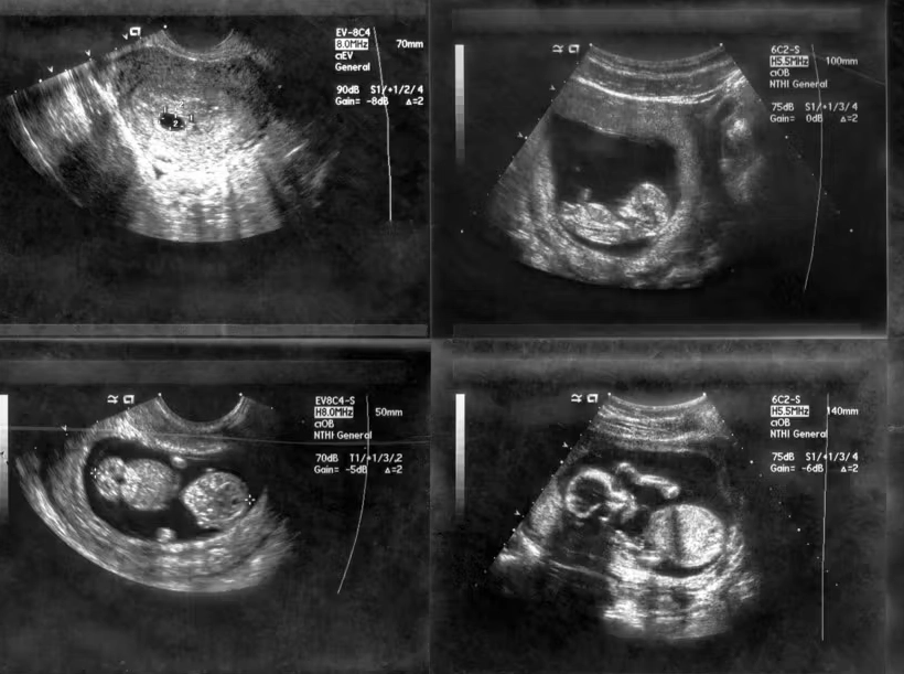 1 week pregnant signs 1 week pregnant signs