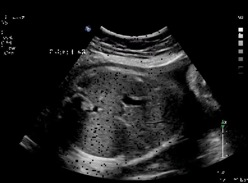 What are red flags in the third trimester?