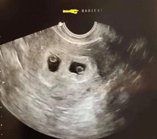 early pregnancy signs week 5