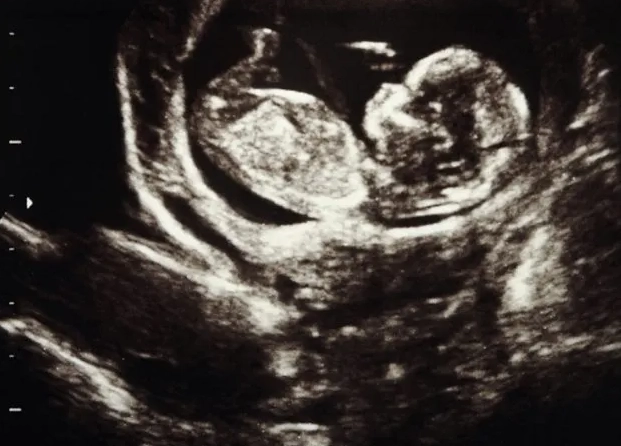 prenatal checkup results