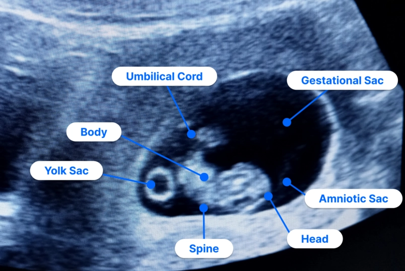 early pregnancy symptoms
