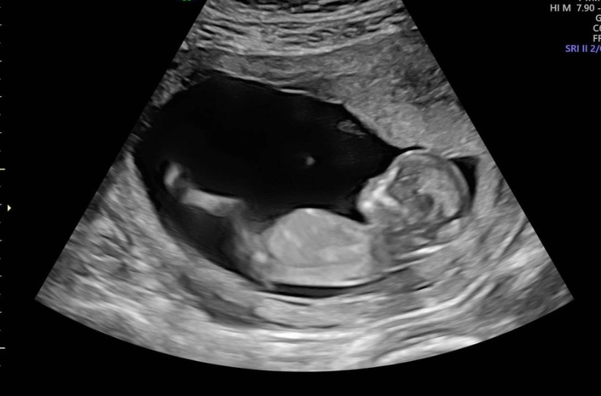 where is baby at 12 weeks ultrasound where is baby at 12 weeks ultrasound