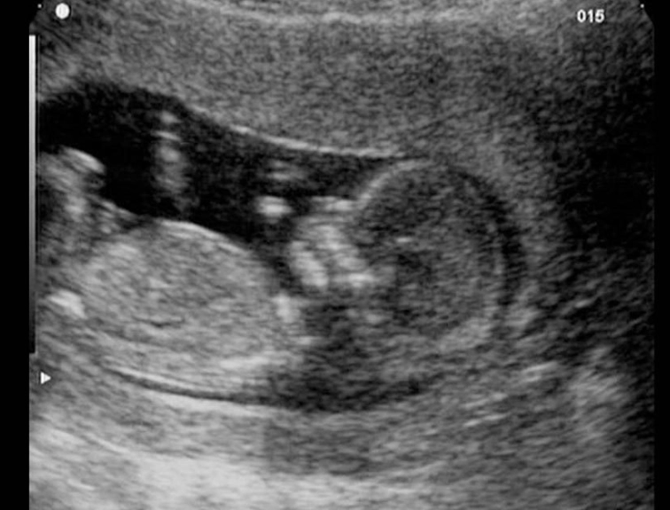 12 weeks pregnant baby position 12 weeks pregnant baby position