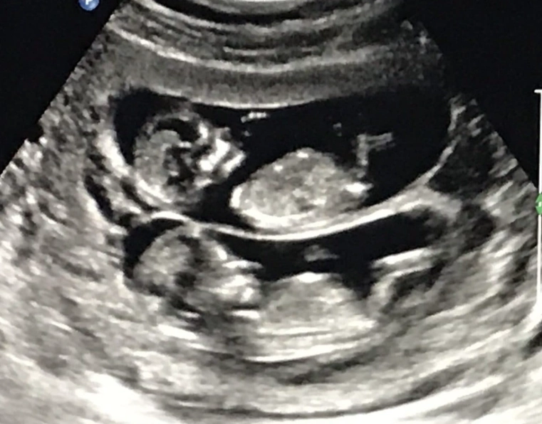 fetal development 12 weeks fetal development 12 weeks