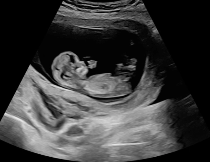 12 week pregnant bump