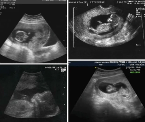 pregnancy trimesters pregnancy trimesters