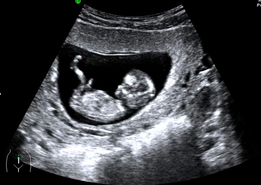 first trimester ultrasound
