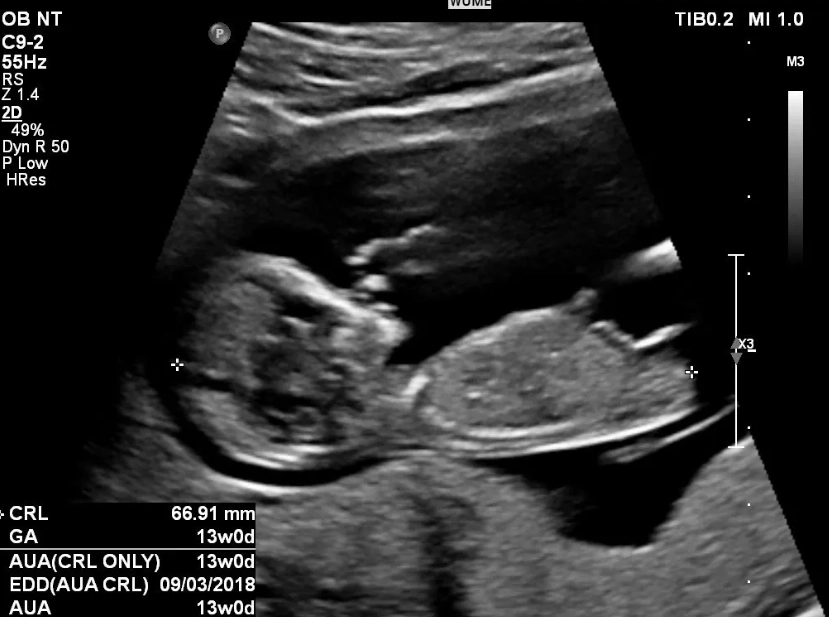 first trimester ultrasound