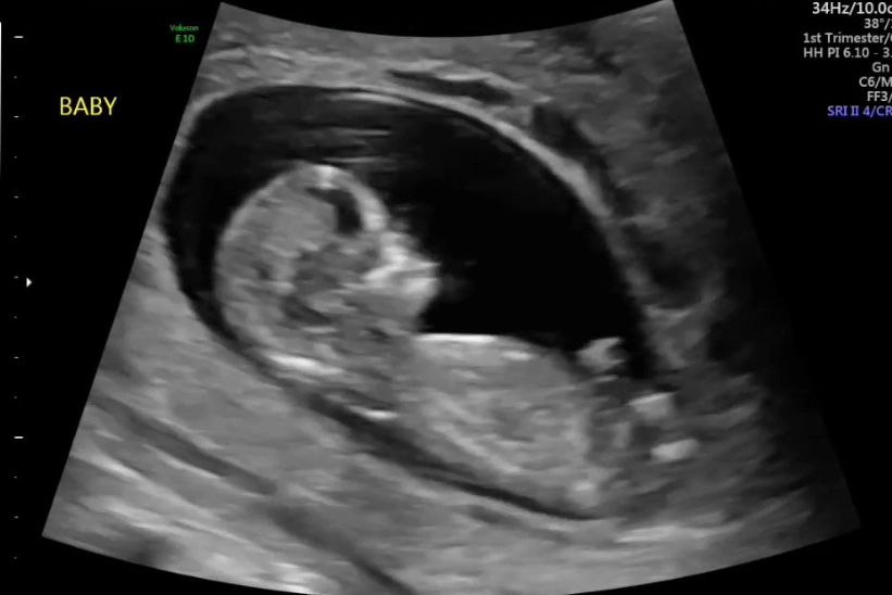 Are you 3 months pregnant at 12 weeks ultrasound